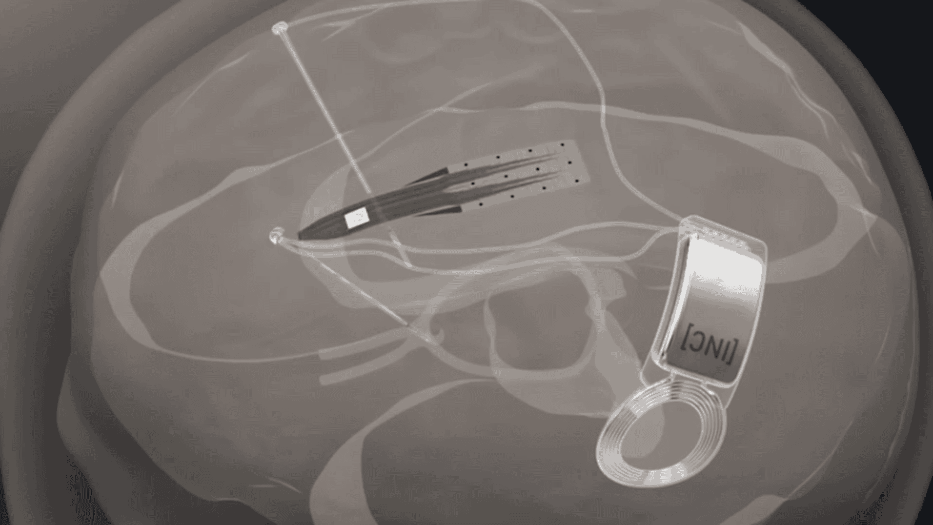 INBRAIN and Microsoft Partner to Develop AI-Powered Brain Interface Tech